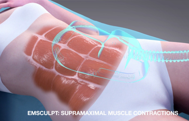 EMSCULPT - Build Muscle Sculpt Your Body | Non-invasive treatment | BTL  Aesthetics
