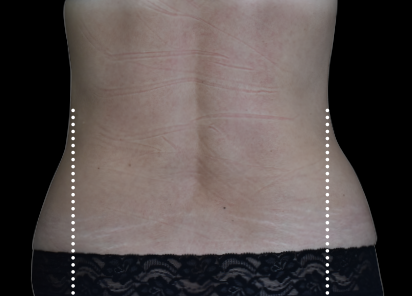 Emsculpt_Neo_PIC_117-after-lateral-abdomen-female-BTL-Aesthetics__412x296px