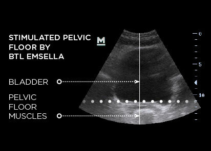 Emsella_PIC_Ba-after-female-pelvic-floor-ultrasound_EN100_412x296