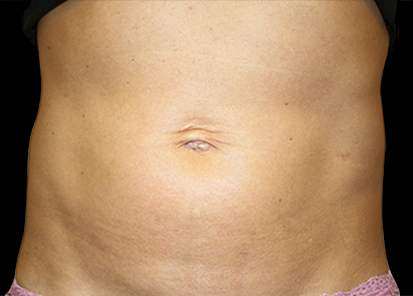Emsculpt_PIC_008-After-abdomen-female-Katerina-Fajkosova-MD-4TX__412x296px