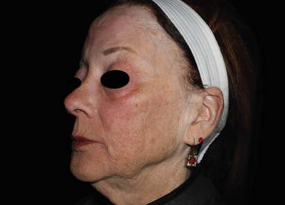 Emface_PIC_052-Before-face-female-Richar-Gentile-MD_412x296px