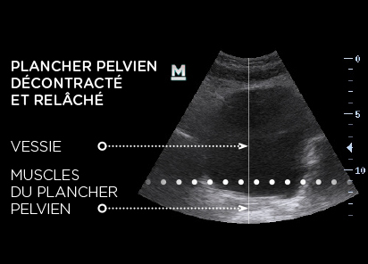 Emsella_PIC_Ba-before-pelvic-ultrasound_FR100